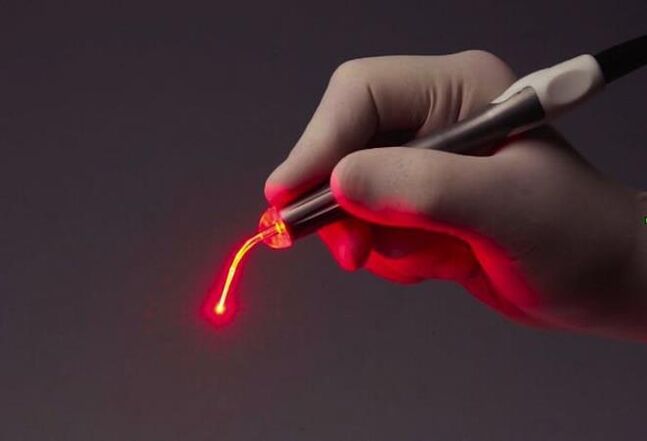 лазер для видалення папіломи у горлі