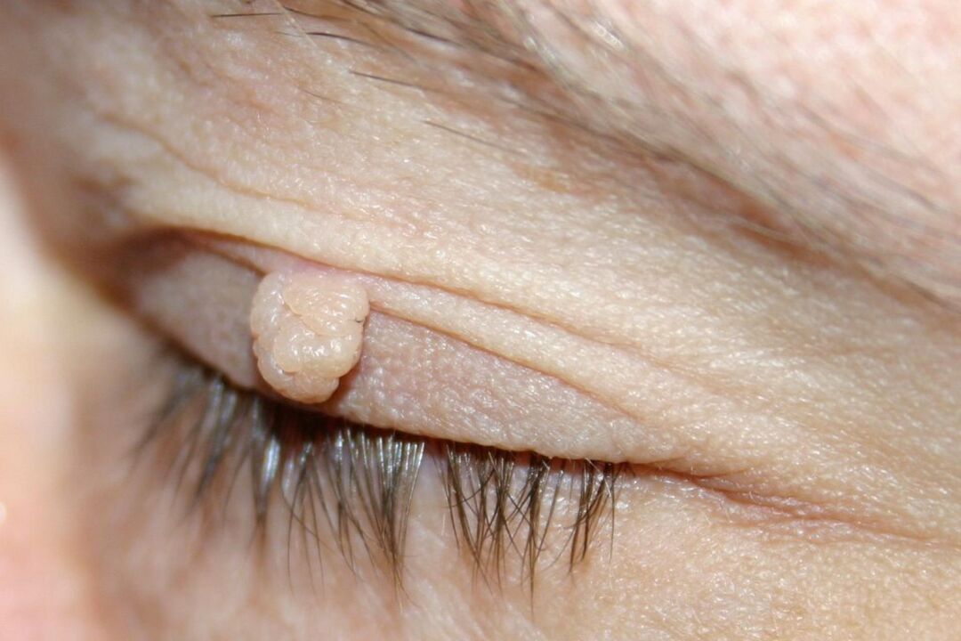 симптоми папіломи на вікі ока